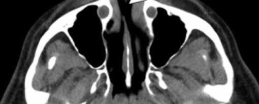 Modelos neuropsicológicos y neuroimagen de las alteraciones cerebrales ocasionadas por la cocaína